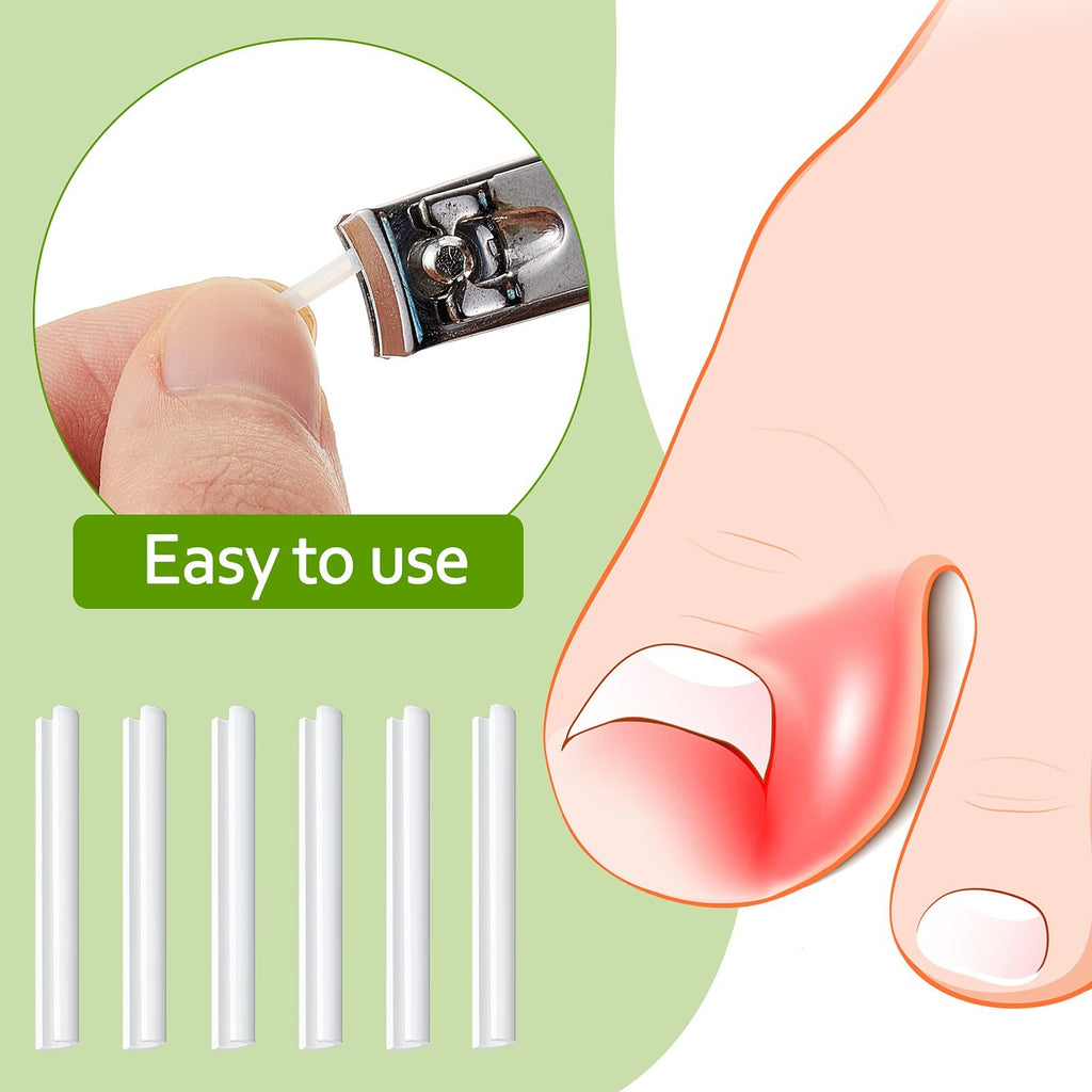 Ingrown Toenail Corrector Strips - Foot Care Treatment for Nail Correction