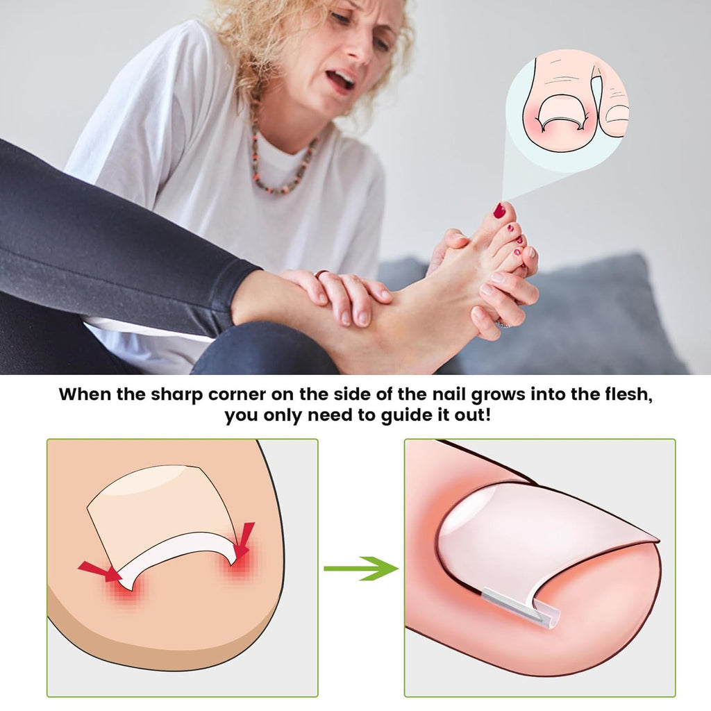 Ingrown Toenail Corrector Set with 40 Pain-Free Straightener Strips and Lifter