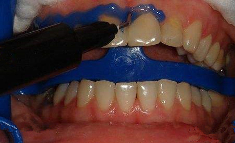Dental Gingival Barrier Gel 5Pcs 3ml Gum Protector for & Acid Treatments