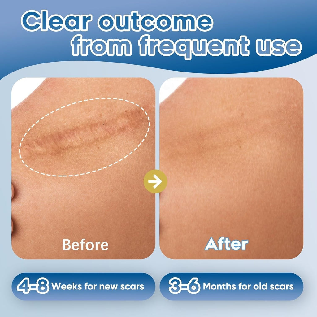 Scar Removal Gel for Surgical & Acne Scars - Silicone, Hydrating Formula