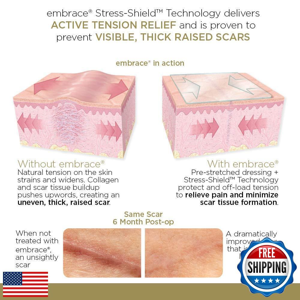 Medical Silicone Scar Sheets for New Hypertrophic & Keloid Scars - 6.3 Inch Extra-Large 30-Day Supply