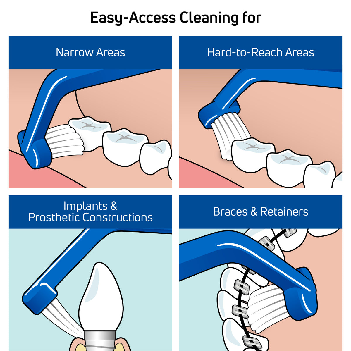 Universal Care Angled Toothbrush for Braces Retainers Implants - 1 Pack