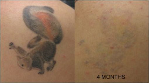 Tattoo Removal Cream 2 Month Supply with Gloves – Tattoo Destroyer Fade