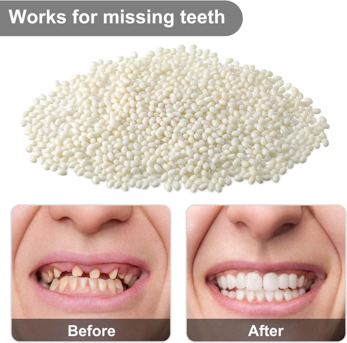 Tooth Repair Kit Moldable Beads for Dental Replacement & Fixing