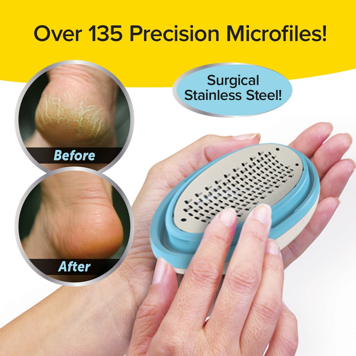 PedEgg Classic Callus Remover for Feet - Exfoliates Dry Skin & Calluses