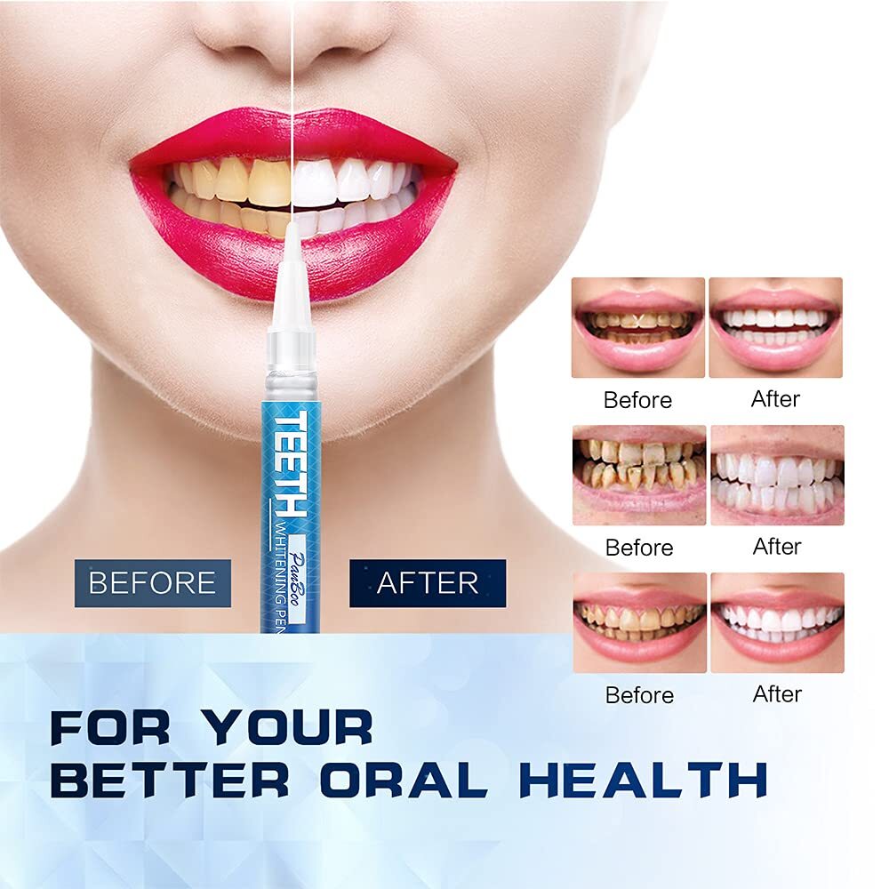 Dental Pen - Professional Gel Quick & Safe Brightening