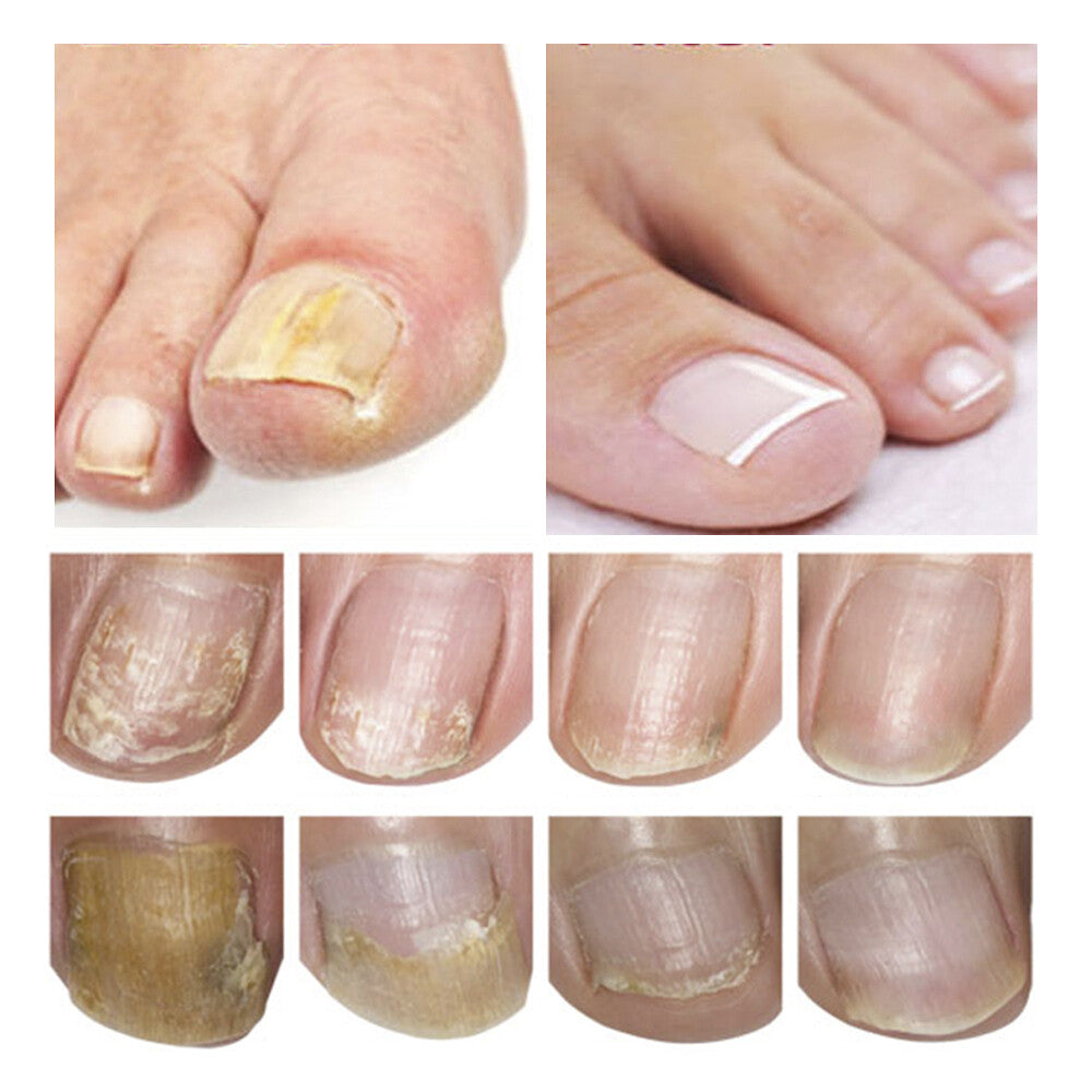 Ginger Antibacterial Nail Treatment Serum for Fungal Repair - 2PCS