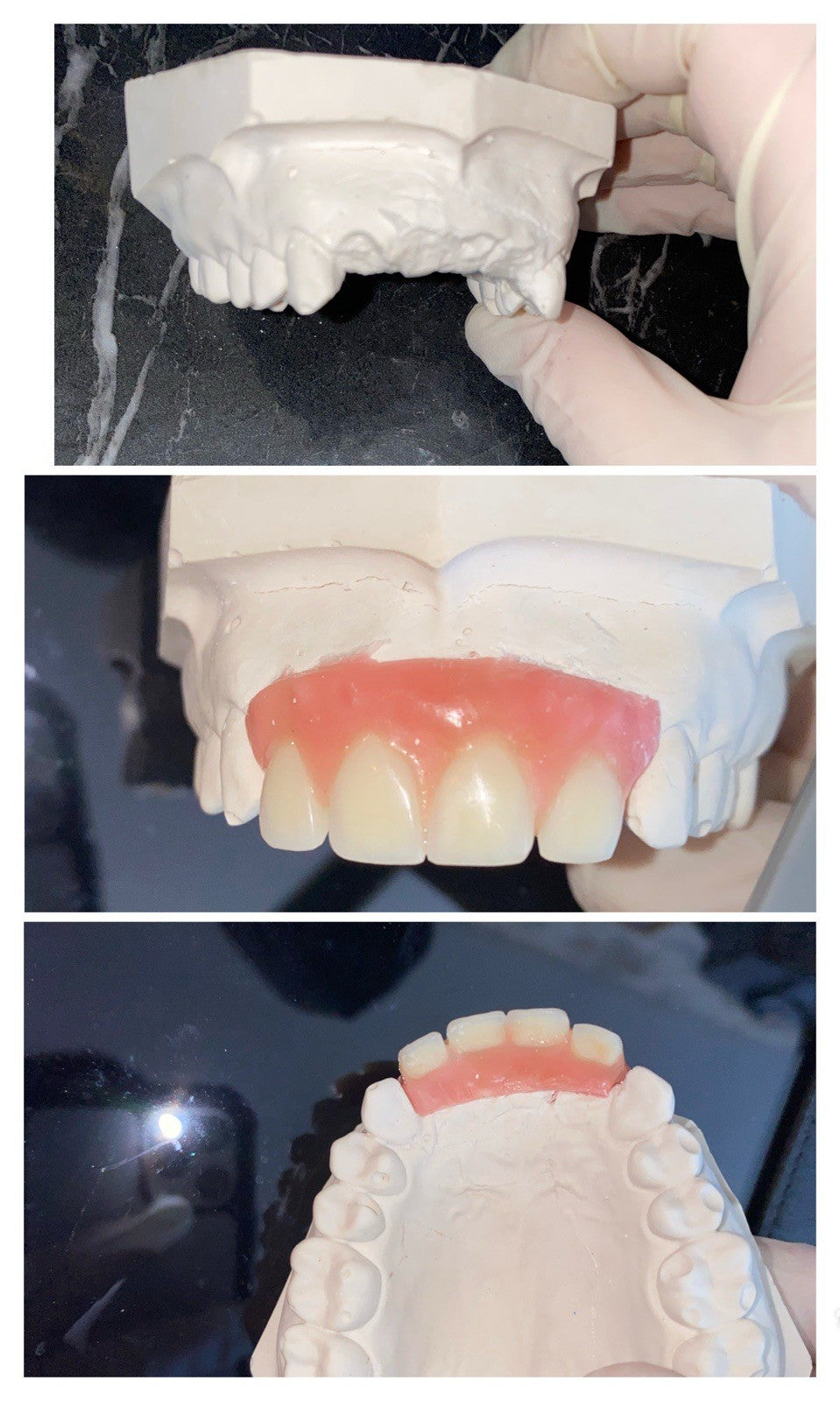 Partial Denture Kit - Make Custom Temporary Teeth A2, Reusable & Easy