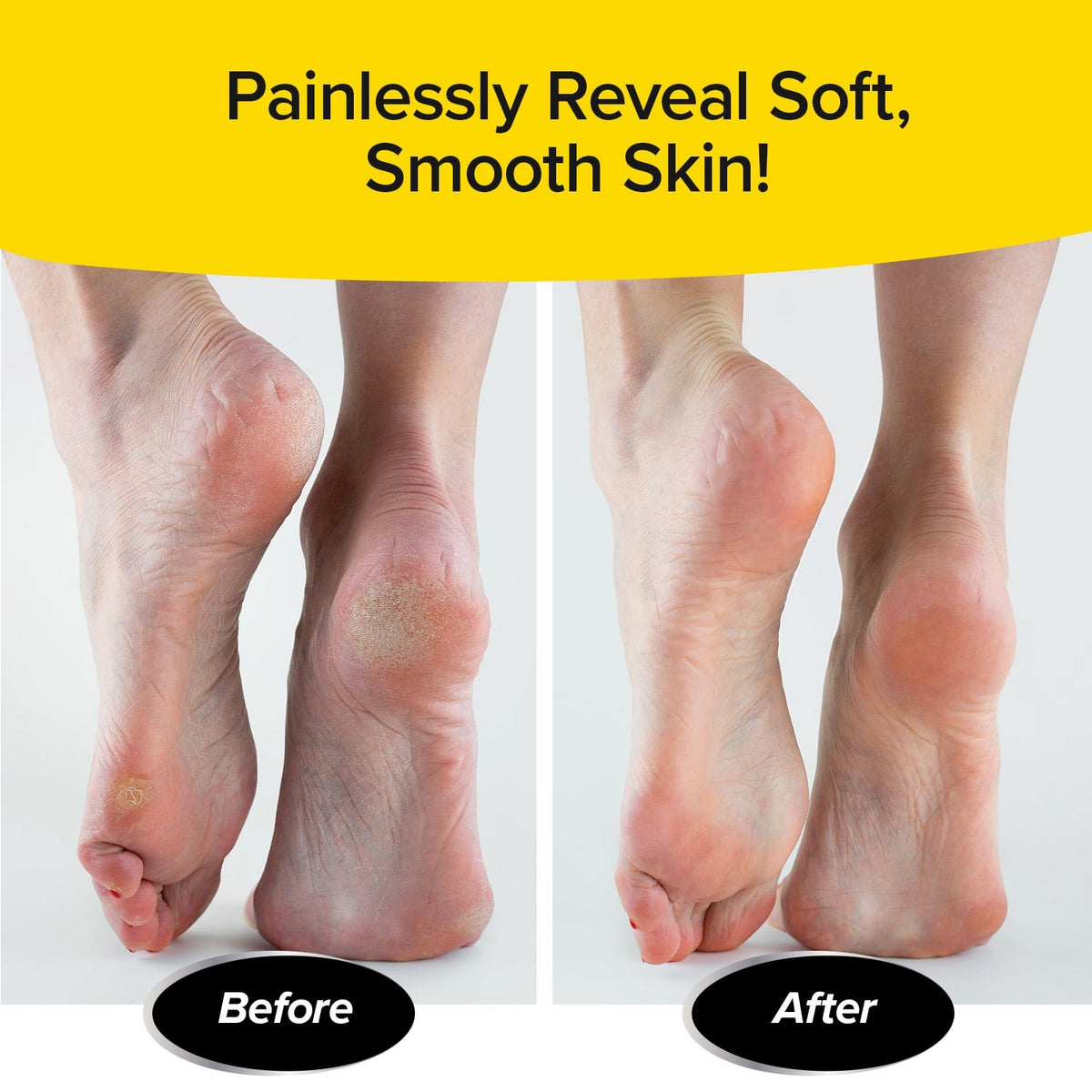 PedEgg Classic Callus Remover for Feet - Exfoliates Dry Skin & Calluses