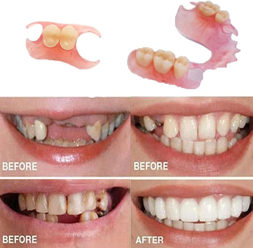 DIY Denture Repair Kit for Partial and Full Temporary Tooth Fixing