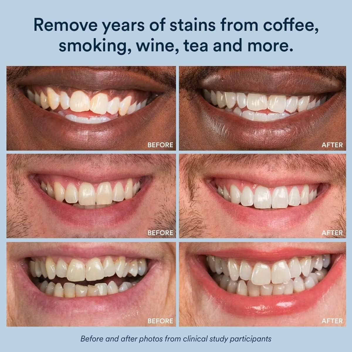 Gel Refill Kit with 35% Carbamide Peroxide for Trays & Aligners