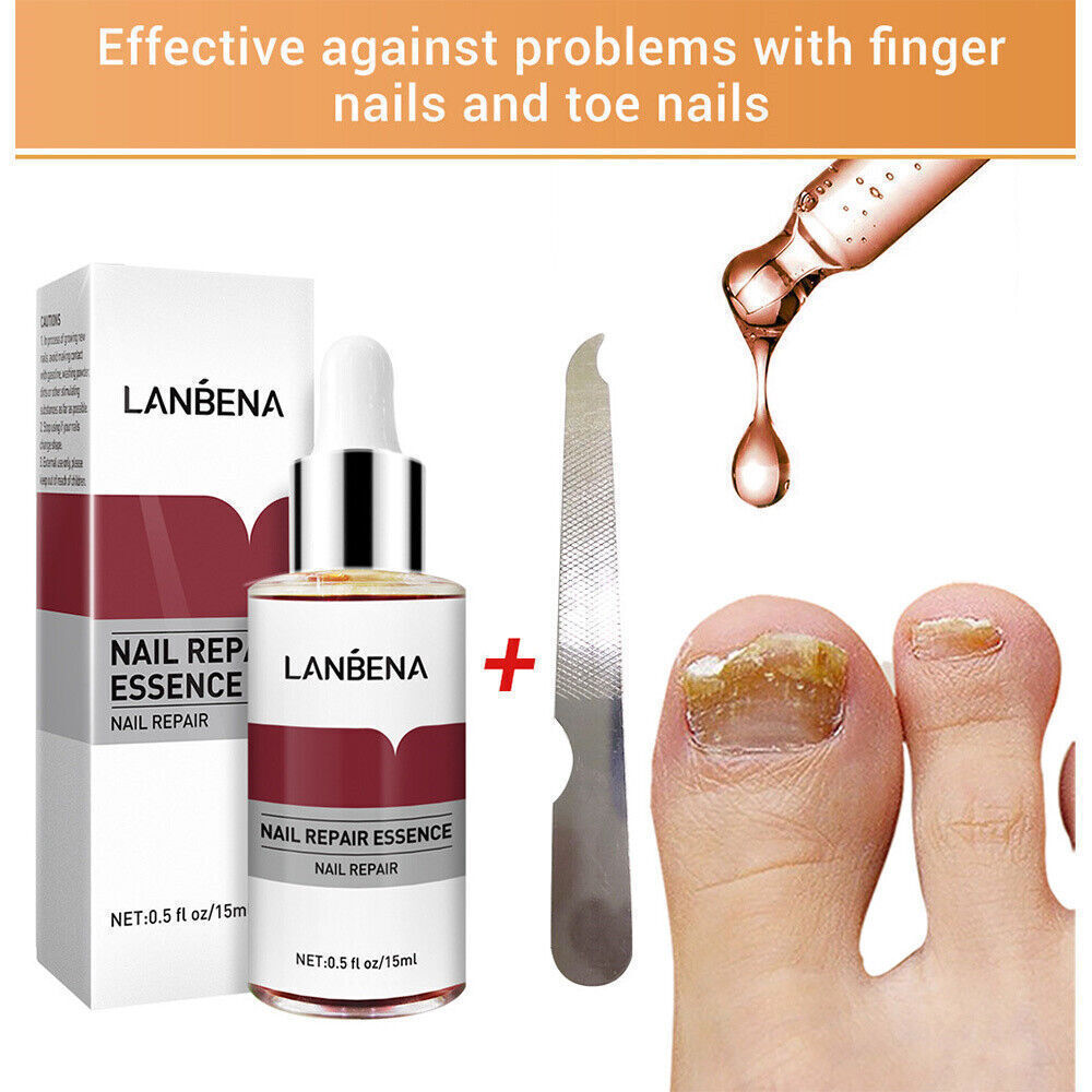 Ginger Antibacterial Nail Treatment Serum for Fungal Repair - 2PCS