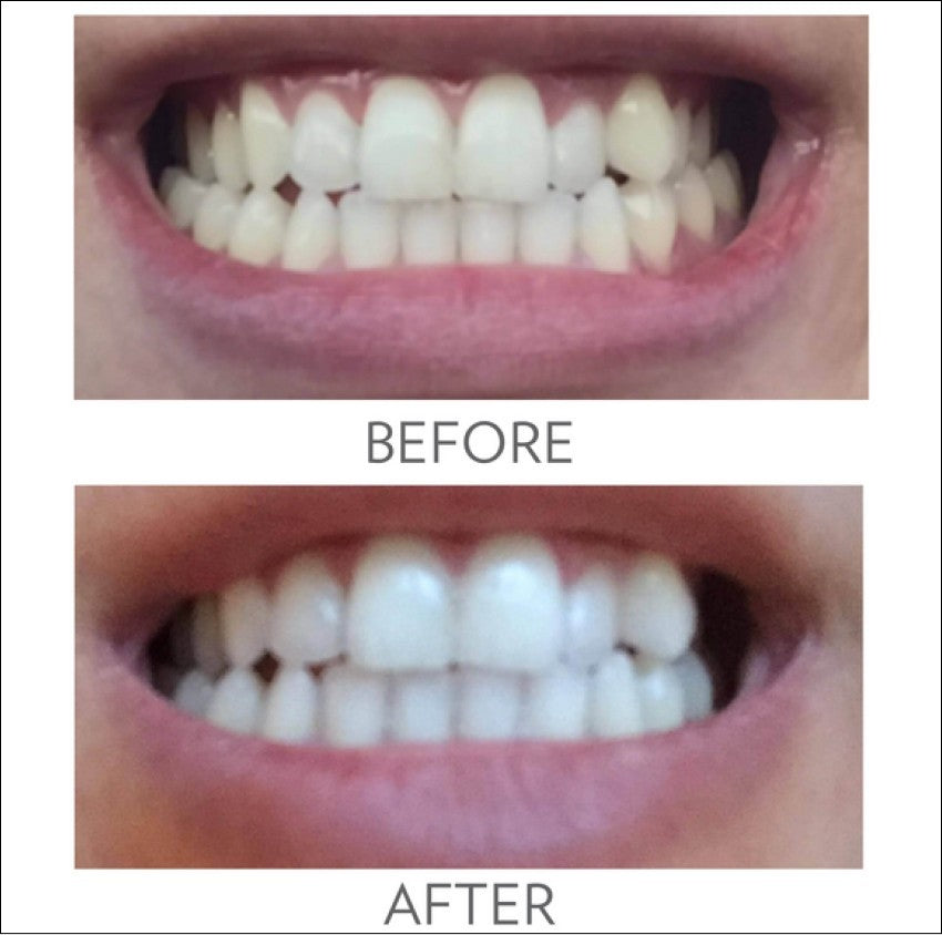 Whitening Fluoride Toothpaste with Fluoride - 6 Pack, No Peroxide