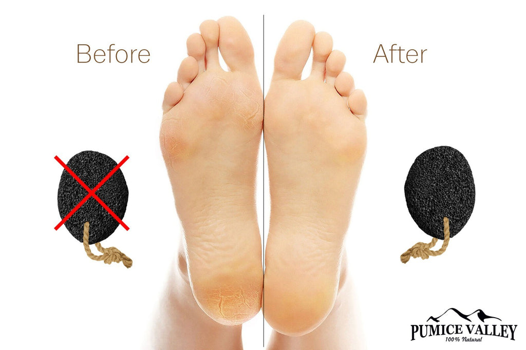 Pumice Stone for Feet and Callus Removal - Foot File and Skin Scrubber