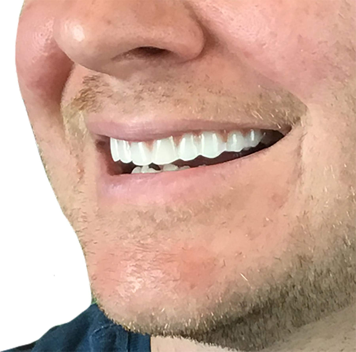 Natural Shade Upper Veneer Cosmetic Teeth - Comfort Fit Flex