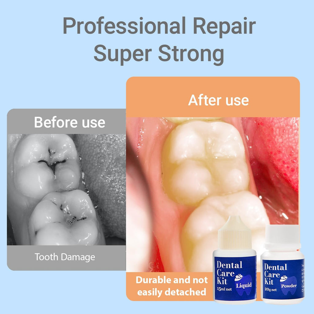 Dental Repair Kit with Zinc Oxide Eugenol - Tooth Filling & Cavity Filler