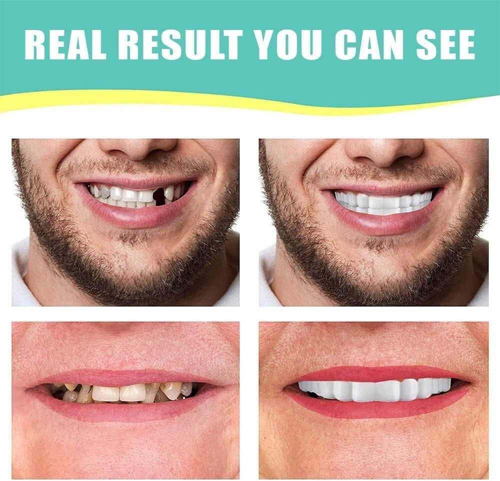 Instant Smile Dental Veneers Set - Upper and Lower Fake Teeth for Cosmetics & Orthodontics