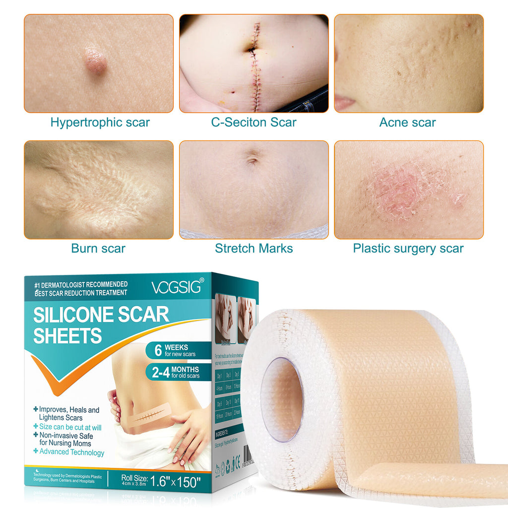 Scar Removal Silicone Tape for Hypertrophic Scars & Keloids - 1.6" x 60"-150"