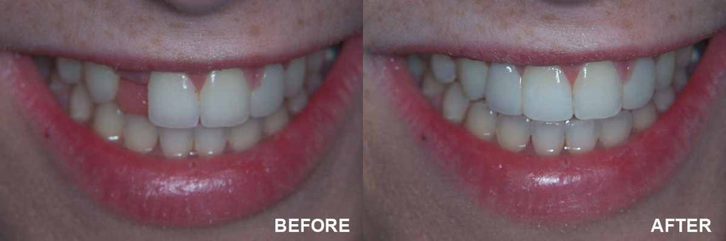 Temporary Teeth Repair Kit - Cosmetic Tooth Replacement System for Missing Dentures