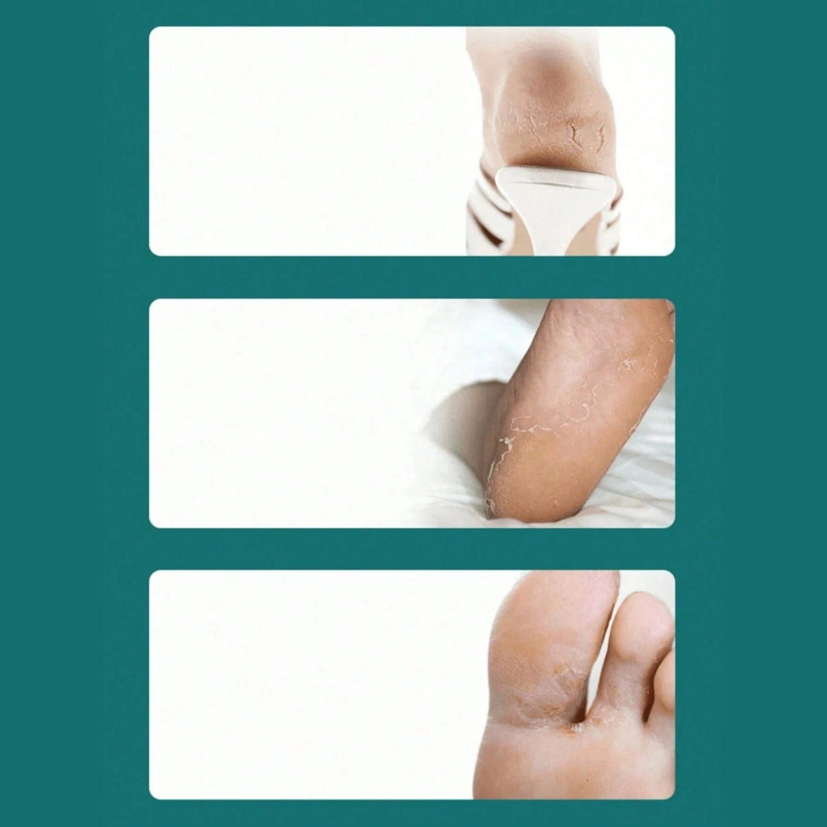 Stainless Steel Foot Scraper Dead Skin & Callus Remover Pedicure Tool