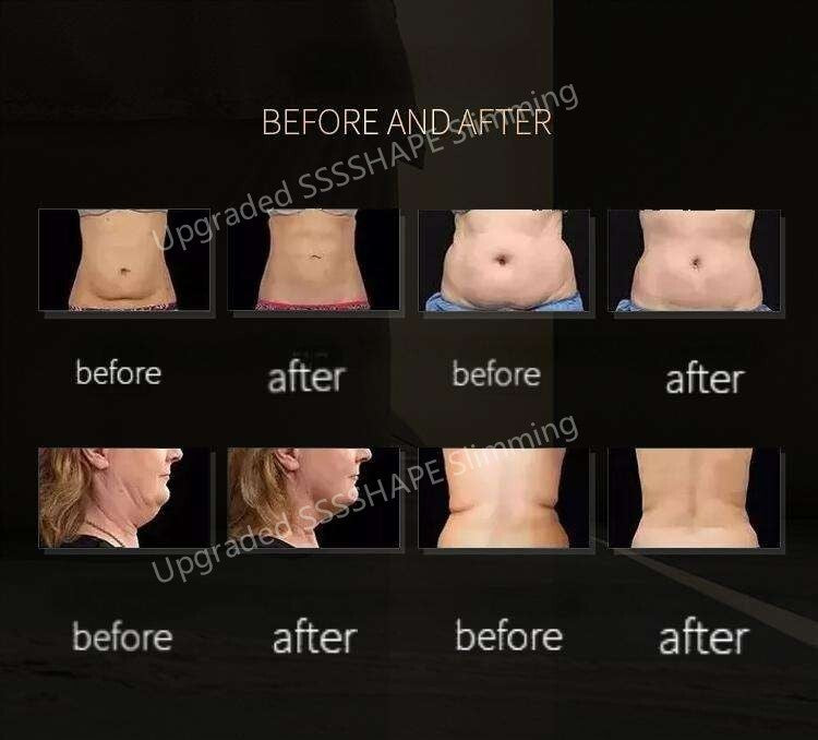 Conductive Slimming Gel for Body Contouring & Fat Reduction - 1/3/5 Pieces