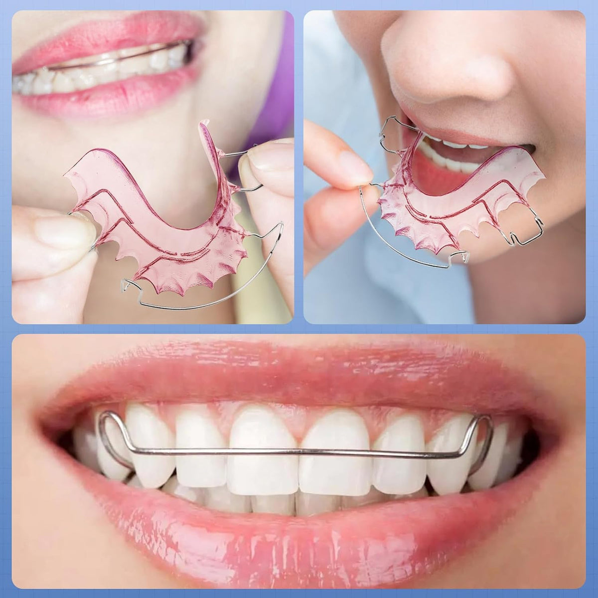 Custom Teeth Retainer Set - 2 Pink Hawley Retainers for Post-Orthodontic Alignment