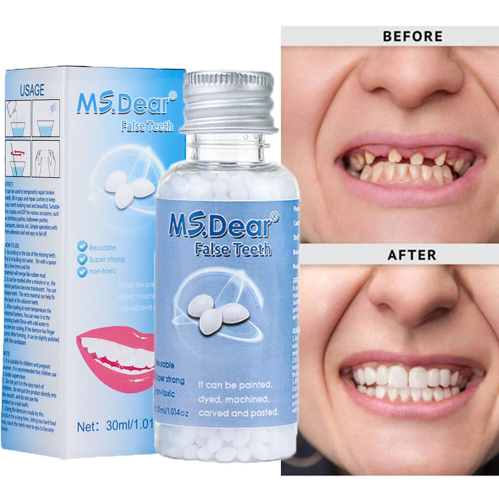 Temporary Dental Repair Kit for Broken Teeth & Cavities - Reusable Teeth Filler