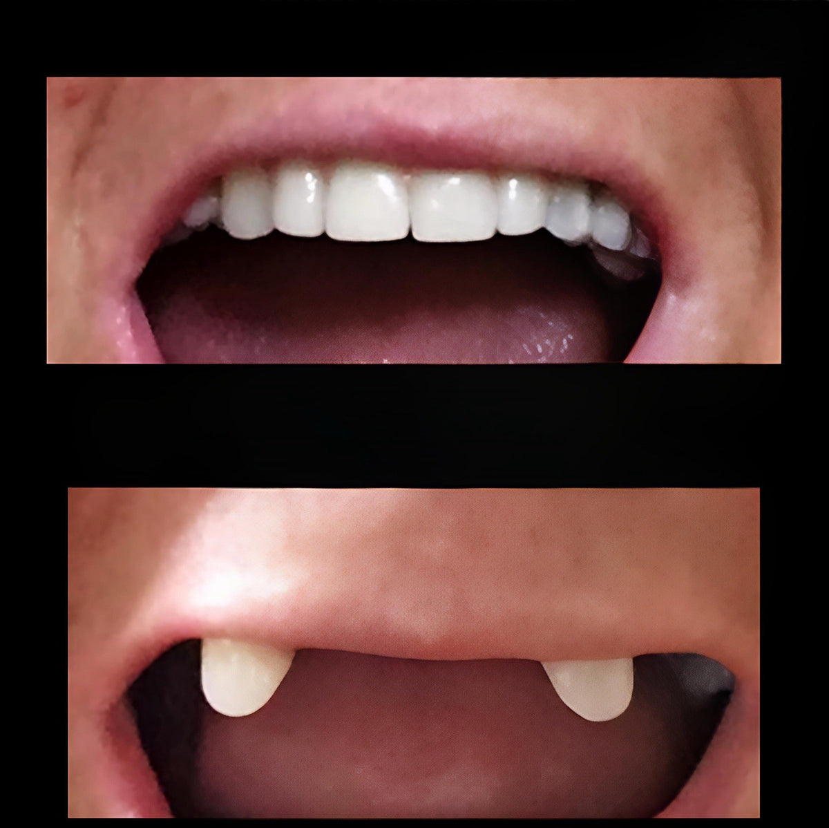 DIY Missing Tooth Replacement Kit - Custom Fit Partial Flipper for 1-6 Front Teeth