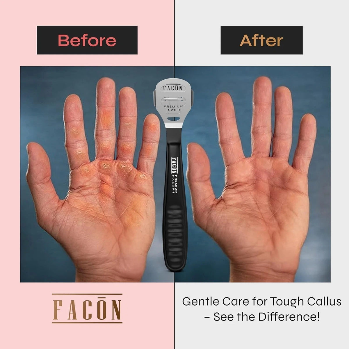 Professional Callus Remover Shaver with 50 Blades - Pedicure Foot Tool
