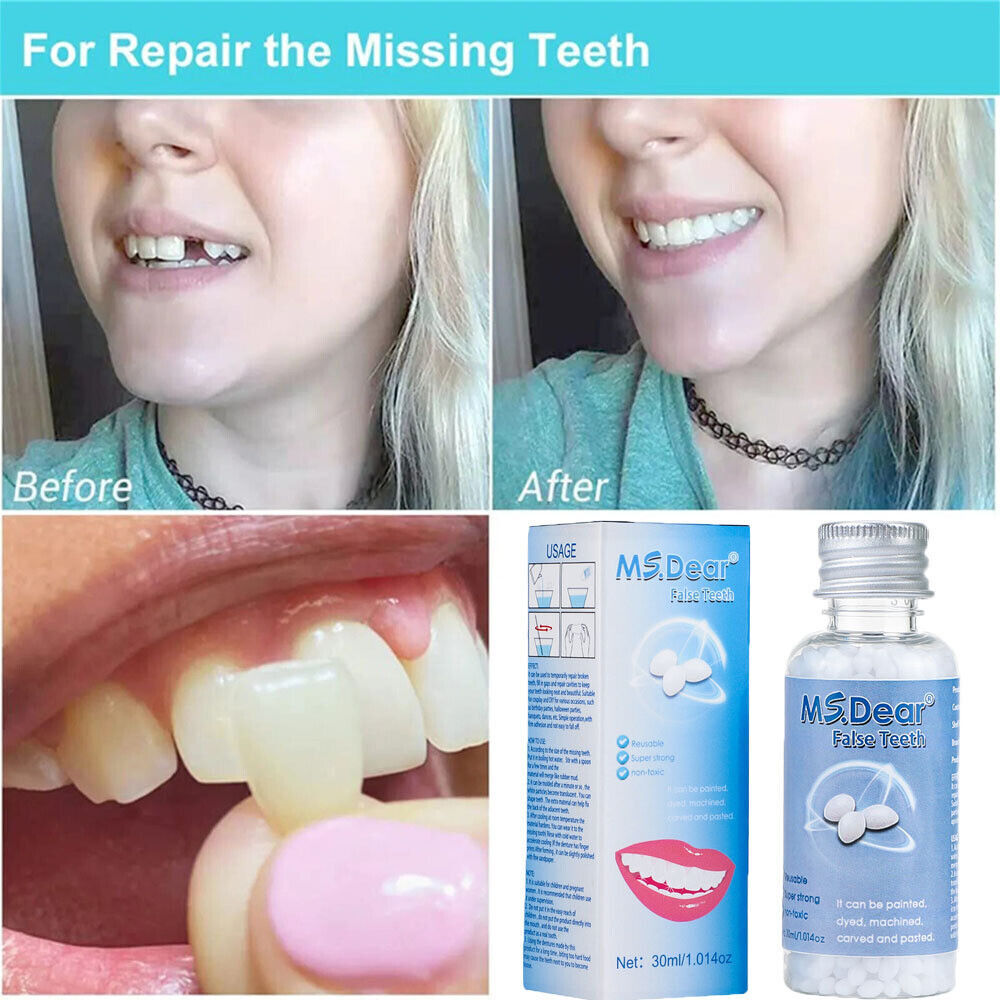 Temporary Teeth Repair Glue for Gaps & Broken Teeth - Moldable Resin