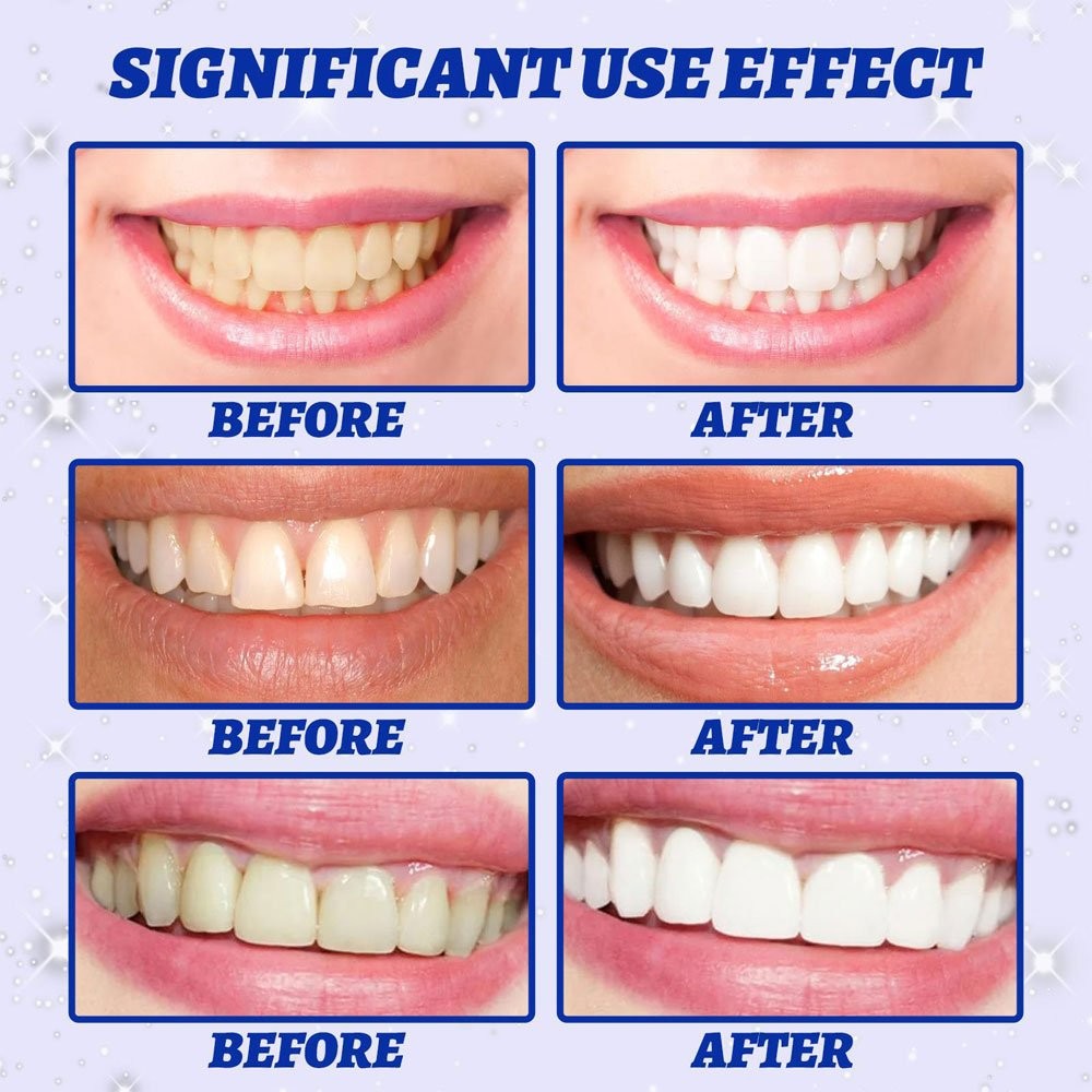 V34 Strips - Safe, Fast, No Peroxide, Multiple Quantities