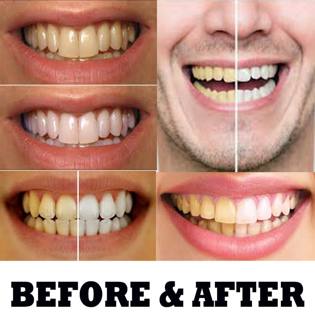 Kit with Gel Syringes & Mouth Trays - Fast Results