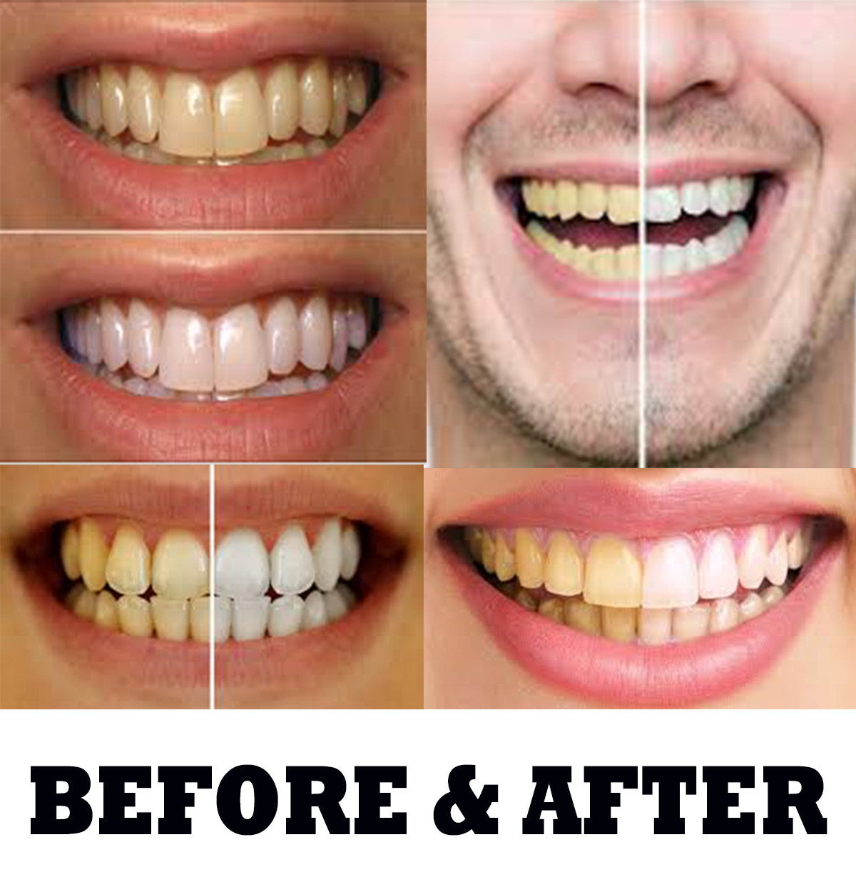 Kit with Gel Syringes & Mouth Trays - Fast Results