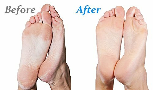 Callus Remover with Extension Handle & Extra Coarse Roller for Foot Care